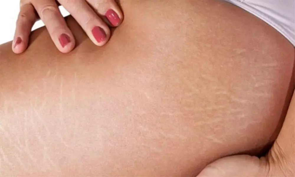 Stretch mark treatment on 1-3 areas at Mesoderm Berlin (save up to 59%)