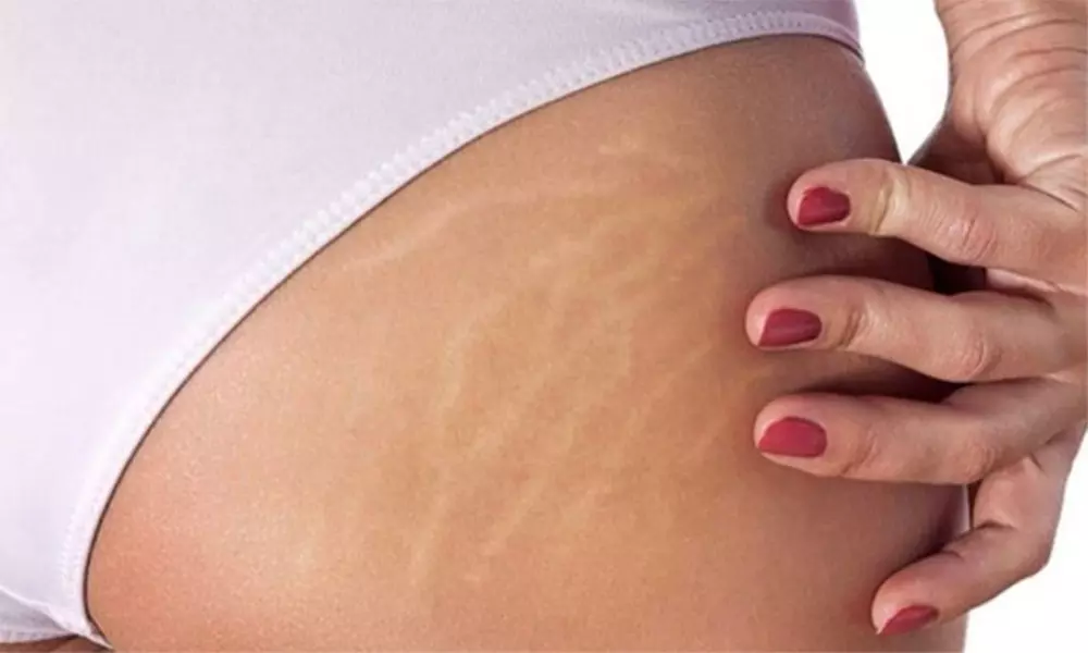 Stretch mark treatment on 1-3 areas at Mesoderm Berlin (save up to 59%)
